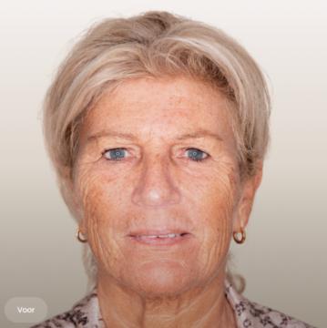 Ooglid chirurgie voor/na van The Body Clinic Amsterdam-Zuid (voor)