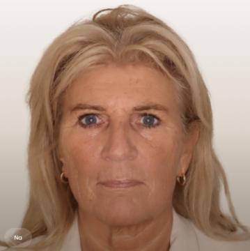 Ooglid chirurgie voor/na van The Body Clinic Amsterdam-Zuid (na)