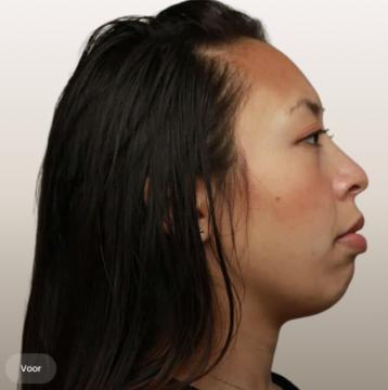 Kin- en kaaklijn voor/na van The Body Clinic Buitenveldert (voor)