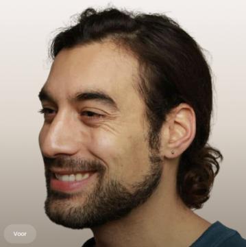 Kraaienpootjes voor/na van The Body Clinic Den Bosch (voor)