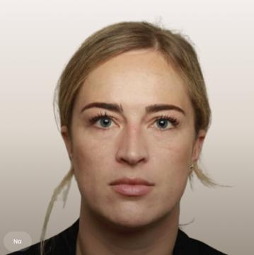 Traangoot / wallen onder ogen voor/na van The Body Clinic Duiven (na)