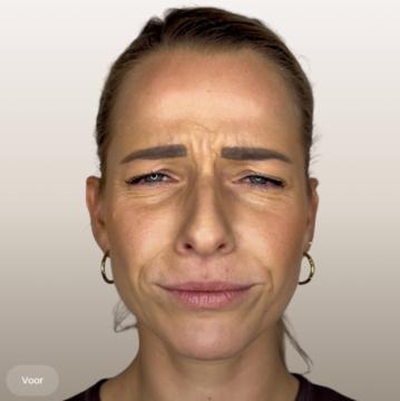 Fronsrimpels voor/na van The Body Clinic Duiven (voor)
