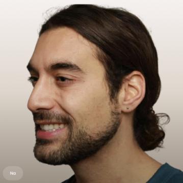 Kraaienpootjes voor/na van The Body Clinic Duiven (na)