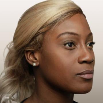 Neus foto van The Body Clinic Duiven (na)