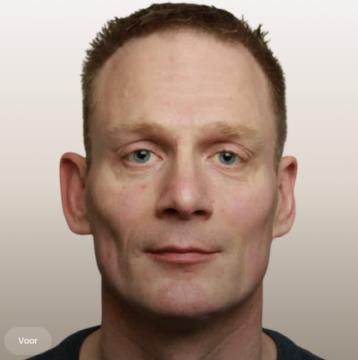 Liquid facelift voor/na van The Body Clinic Eindhoven (voor)