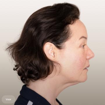 Onderkin voor/na van The Body Clinic Groningen (voor)