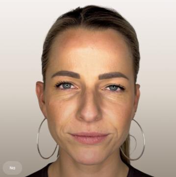 Fronsrimpels voor/na van The Body Clinic Maastricht (na)