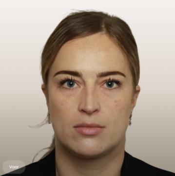 Traangoot / wallen onder ogen foto van The Body Clinic Rotterdam (voor)