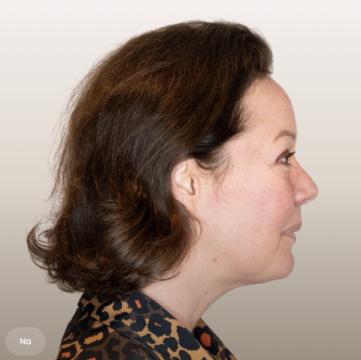 Onderkin voor/na van The Body Clinic Utrecht (na)