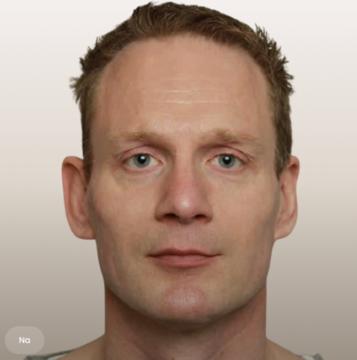 Liquid facelift voor/na van The Body Clinic Utrecht (na)