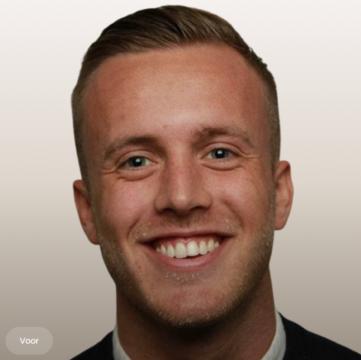 Tandvlees glimlach foto van The Body Clinic Blaricum (voor)