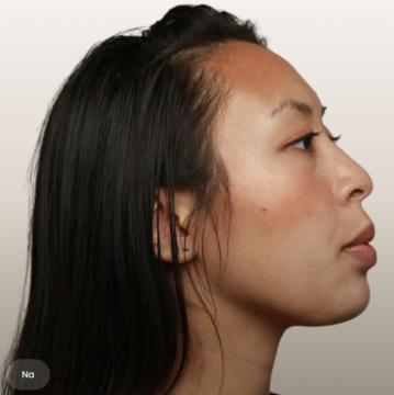 Kin- en kaaklijn voor/na van The Body Clinic Blaricum (na)