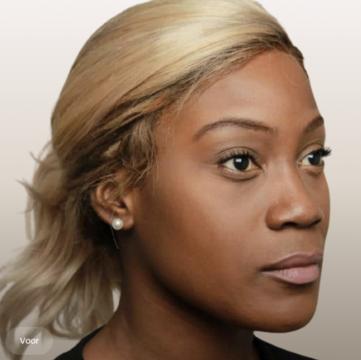 Neus foto van The Body Clinic Blaricum (voor)