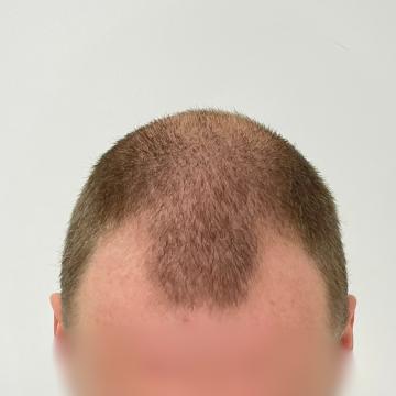 Haartransplantatie foto van Anatomy 43 (voor)