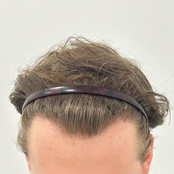 Haartransplantatie foto van Anatomy 43 (na)