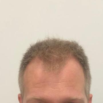 Haartransplantatie foto van Anatomy 43 (voor)