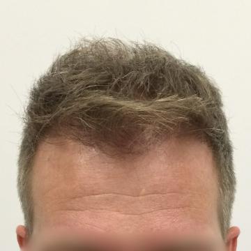 Haartransplantatie foto van Anatomy 43 (na)