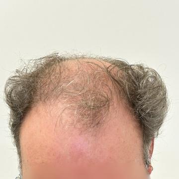 Haartransplantatie foto van Anatomy 43 (voor)