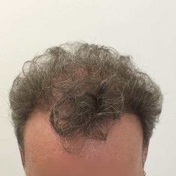 Haartransplantatie foto van Anatomy 43 (na)