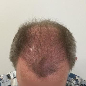 Haartransplantatie foto van Anatomy 43 (voor)
