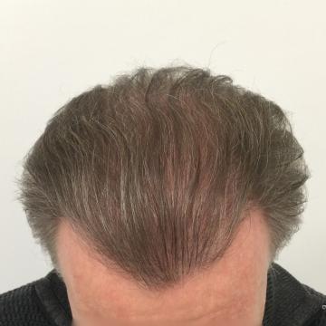 Haartransplantatie foto van Anatomy 43 (na)