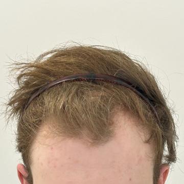 Haartransplantatie foto van Anatomy 43 (voor)