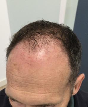 Haartransplantatie foto van Anatomy 43 (voor)