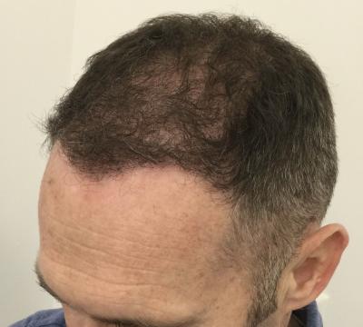 Haartransplantatie foto van Anatomy 43 (na)