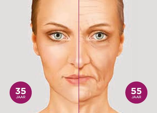 Sculptra behandeling