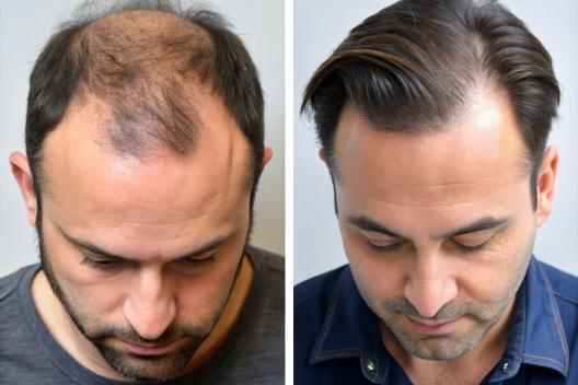 Alles wat je moet weten over haartransplantatie