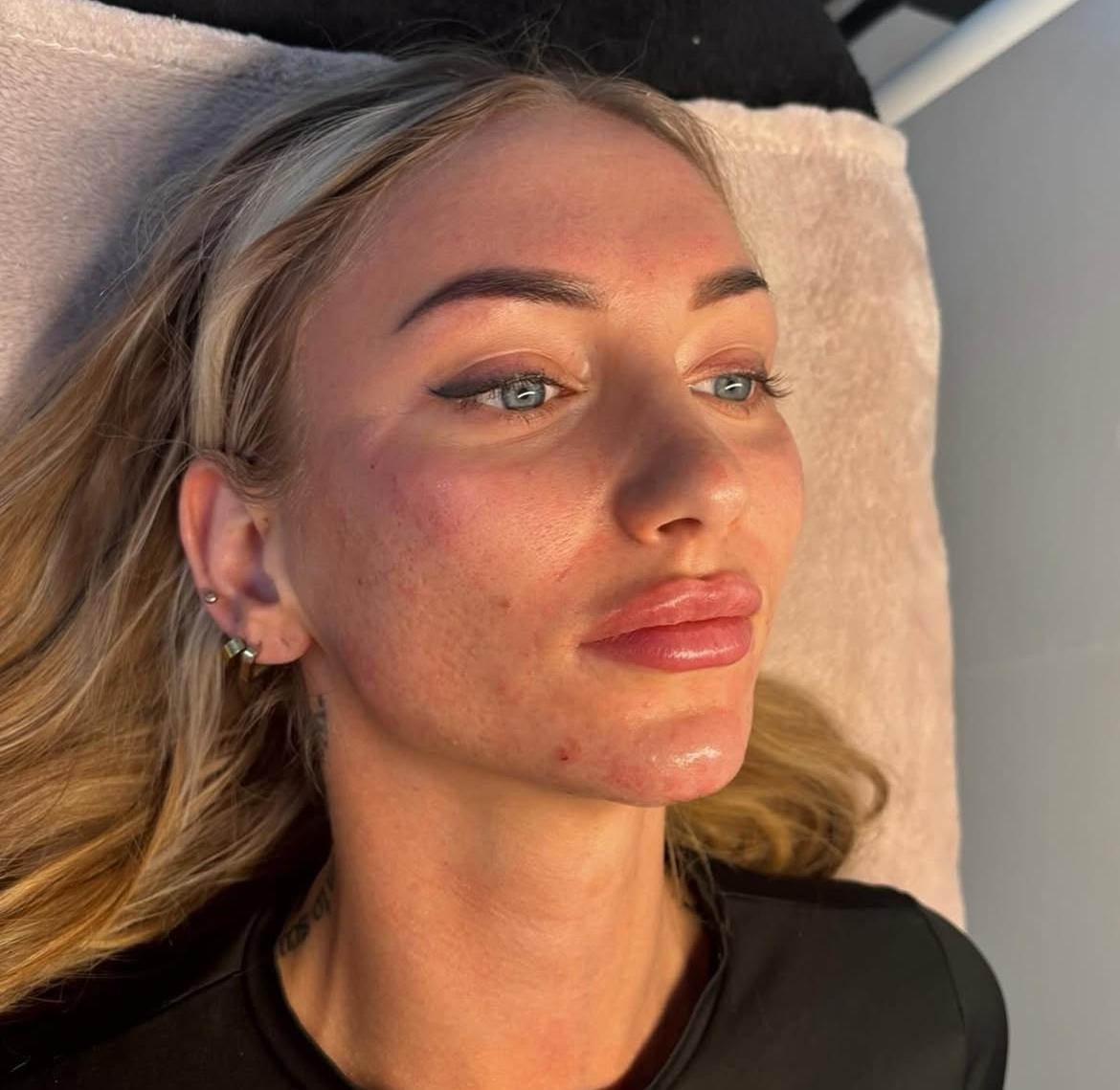 Injectables behandeling voor rimpels in Hoogstraten bij House of Taupe Hoogstraten