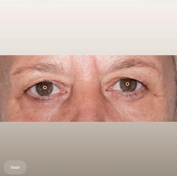Ooglid chirurgie foto van The Body Clinic Den Bosch (voor)