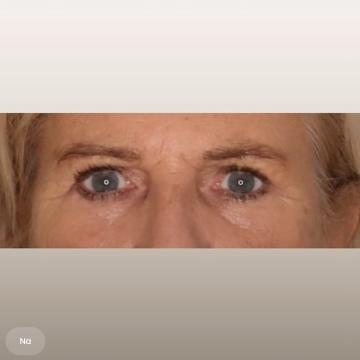 Ooglid chirurgie foto van The Body Clinic Den Bosch (na)