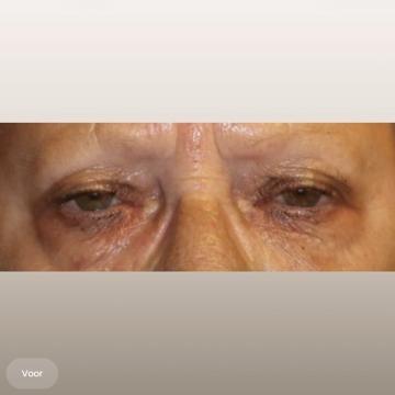 Ooglid chirurgie foto van The Body Clinic Den Bosch (voor)