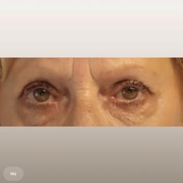 Ooglid chirurgie foto van The Body Clinic Den Bosch (na)