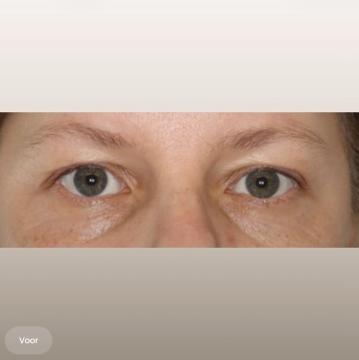 Ooglid chirurgie foto van The Body Clinic Den Bosch (voor)