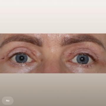 Ooglid chirurgie foto van The Body Clinic Eindhoven (na)