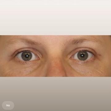 Ooglid chirurgie foto van The Body Clinic Groningen (na)