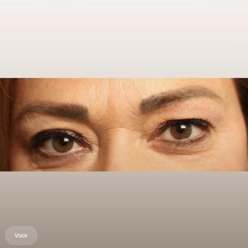 Ooglid chirurgie foto van The Body Clinic Duiven (voor)