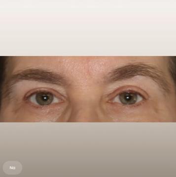 Ooglid chirurgie foto van The Body Clinic Duiven (na)