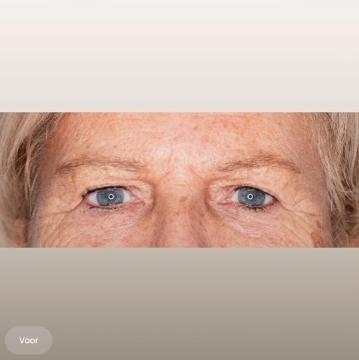 Ooglid chirurgie foto van The Body Clinic Duiven (voor)