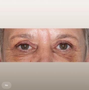 Ooglid chirurgie voor/na van The Body Clinic Heerenveen (na)