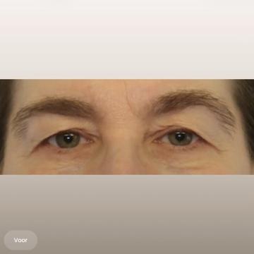 Ooglid chirurgie voor/na van The Body Clinic Heerenveen (voor)