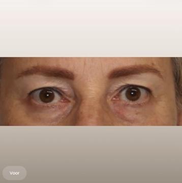 Ooglid chirurgie voor/na van The Body Clinic Heerenveen (voor)