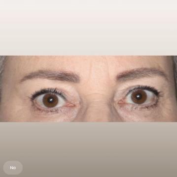 Ooglid chirurgie voor/na van The Body Clinic Heerenveen (na)