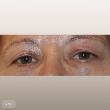 Ooglid chirurgie voor/na van The Body Clinic Heerenveen (voor)