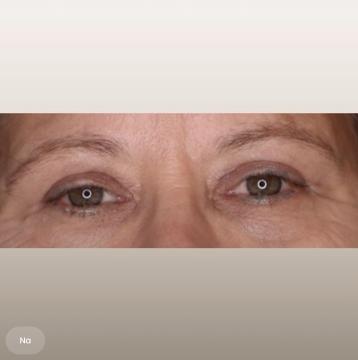 Ooglid chirurgie voor/na van The Body Clinic Heerenveen (na)