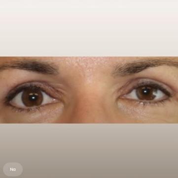 Ooglid chirurgie voor/na van The Body Clinic Heerenveen (na)