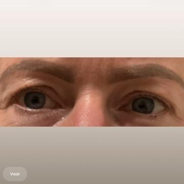 Ooglid chirurgie voor/na van The Body Clinic Heerenveen (voor)