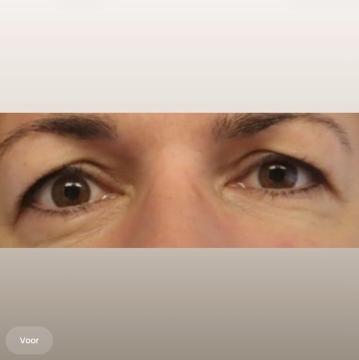 Ooglid chirurgie foto van The Body Clinic Utrecht (voor)